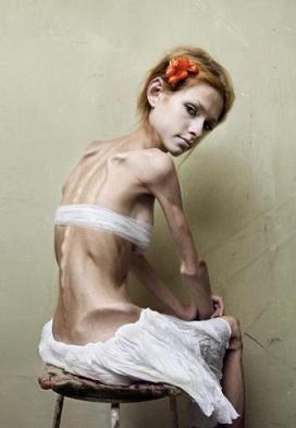 Halálos koplalás - Így ismerheted fel, ha anorexiás a gyereked | paneer.hu